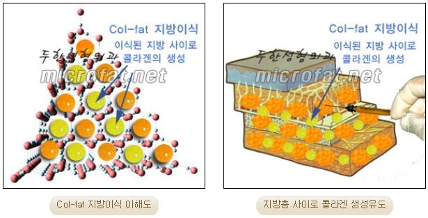 [두한성형외과 미세지방이식] - [자가지방이식] 관련 이미지 3