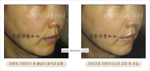 [두한성형외과 경쟁력 미세지방이식] - [타 병원에서 볼살 지방이식 이후 부작용 교정 방법 안내] 관련 이미지 5