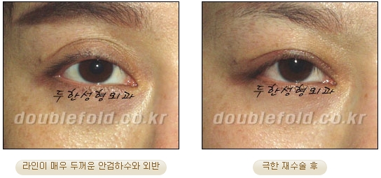두한성형외과 눈재수술 - 쌍꺼풀 재수술 방법 관련 이미지 71