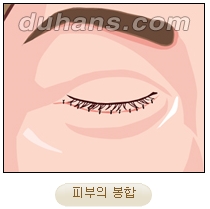 [두한성형외과 안검성형] - [상안검, 하안검] 관련 이미지 21