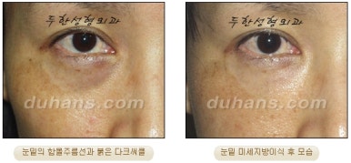 두한성형외과 눈밑성형 - 눈밑지방제거, 눈밑주름, 눈밑지방재배치 관련 이미지 82
