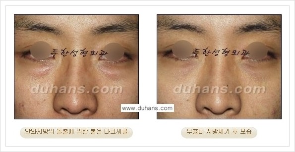 [두한성형외과 경쟁력 안검성형] - [눈밑 지방제거 안내] 관련 이미지 23