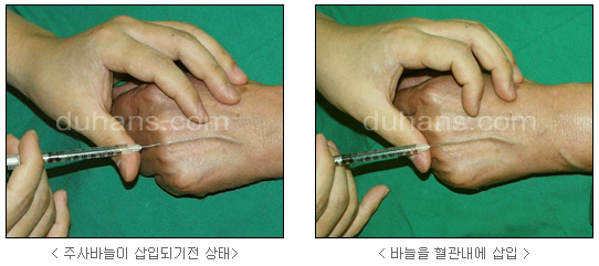 [두한성형외과 정맥류] - [하지정맥류, 정맥확장증, 혈관확장증] 관련 이미지 51