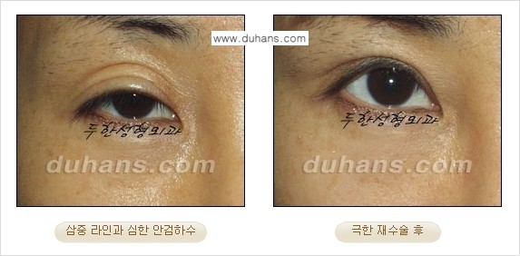 [두한성형외과 경쟁력 눈성형] - [두꺼운 라인을 교정하는 극한 눈 재수술 2.] 관련 이미지 11