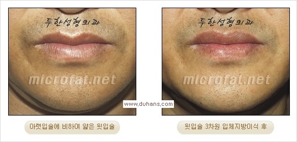 ​​​[두한성형외과 경쟁력 지방이식] - [지방이식을 이용한 입술성형 안내] 관련 이미지 11