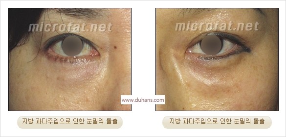 [두한성형외과 경쟁력 미세지방이식] - [타 병원의 지방이식 부작용 교정 - 정교한 마이크로 지방이식, 흡입 안내] 관련 이미지 4