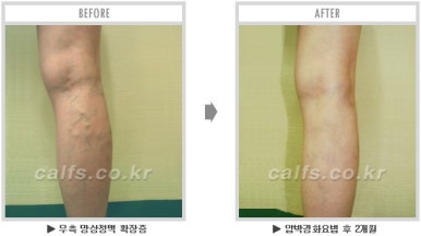 ​[두한성형외과 종아리수술] - [나에게 맞는 종아리성형방법] 관련 이미지 50