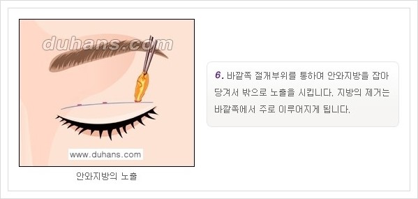 [두한성형외과 경쟁력 눈성형, 쌍꺼풀 수술] - [퀵쌍꺼풀(부분절개법)의 수술 안내] 관련 이미지 7