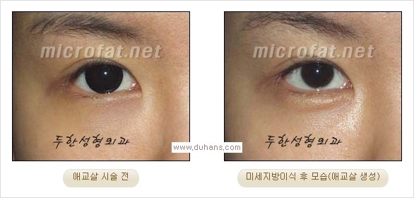 [두한성형외과 경쟁력 눈밑성형] - [타 병원 필러 애교살 시술 부작용을 미세지방이식으로 교정] 관련 이미지 28