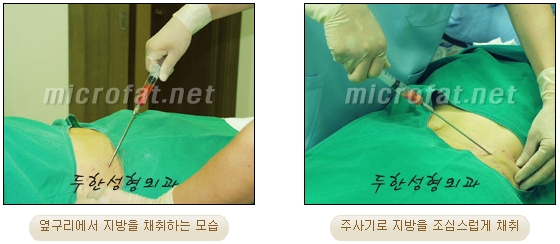 [Duhan Plastic Surgery Lip Surgery] - [Lip Correction Fat Grafting] image 4