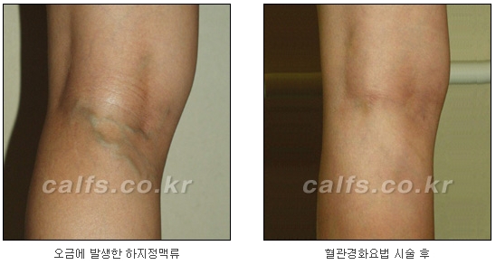 ​[두한성형외과 종아리성형] - [나에게 맞는 종아리시술] 관련 이미지 31