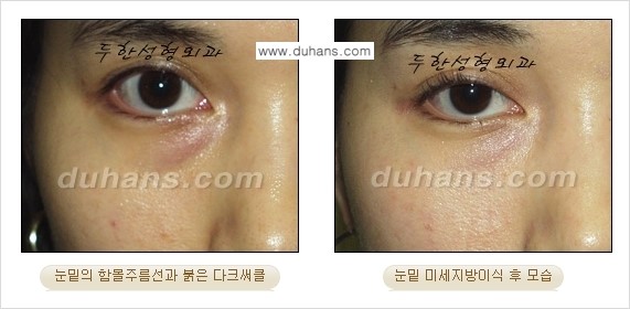 [두한성형외과 경쟁력 미세지방이식] - [다크써클 & 눈밑주름 미세지방이식 4.] 관련 이미지 15