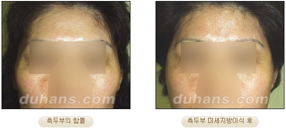 [두한성형외과 얼굴자가지방이식] - [볼살, 이마, 측두부] 관련 이미지 9
