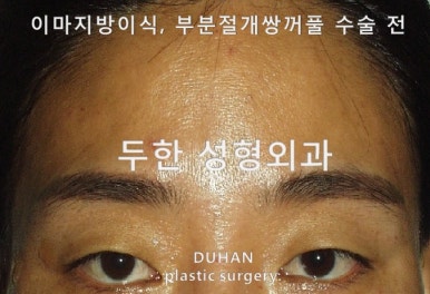 [Duhan Plastic Surgery Eye Surgery] - [Quick Double Eyelid Surgery] image 24