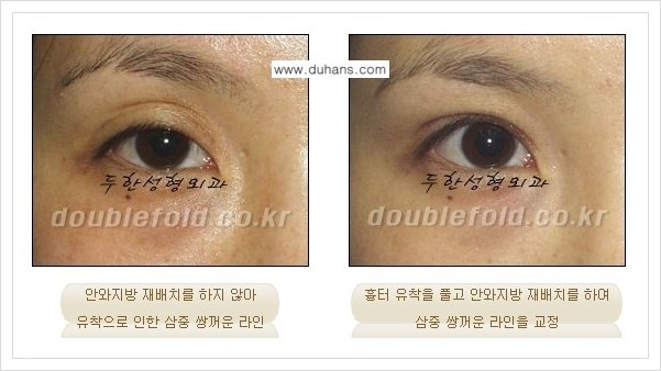 [두한성형외과 경쟁력 쌍꺼풀(눈) 재수술] - [쌍꺼풀(눈) 재수술, 극한 재수술 클리닉의 특성] 관련 이미지 2