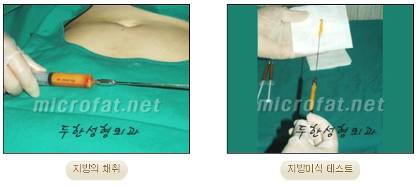 [두한성형외과 미세지방이식] - [자가지방이식] 관련 이미지 6