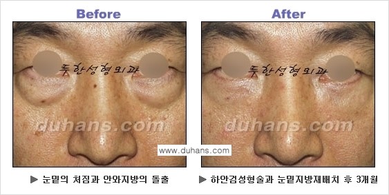 [두한성형외과의 상큼하고 환한 젊은 눈매완성] - [하안검 성형술 ①] 관련 이미지 21