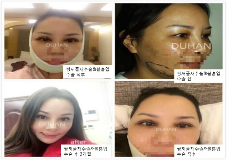 [Du Han Plastic Surgery] - [Double eyelid revision surgery, double eyelid surgery, double eyelid revision, double eyelid surgery, facial fat liposuction, chin fat liposuction] image 2