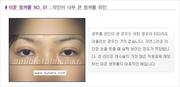 [두한성형외과 경쟁력 눈성형] - [미운 쌍꺼풀이란?] 관련 이미지 2