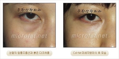 두한성형외과 눈밑수술 - 다크서클 수술 전후 관리 안내 관련 이미지 29