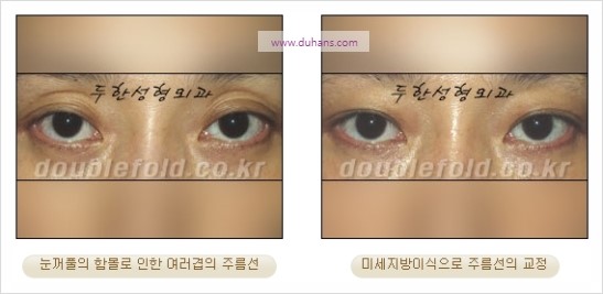 [두한성형외과 경쟁력 눈성형] - [쌍꺼풀 재수술 과정과 쌍꺼풀 재수술 실패의 원인, 쌍꺼풀 재수술의 성공 요건] 관련 이미지 56