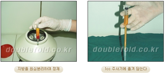 눈재수술잘하는곳 두한성형외과 - 짝눈쌍꺼풀수술 관련 이미지 46
