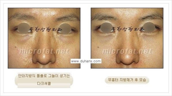 [두한성형외과 경쟁력 눈밑성형] - [눈밑지방제거, 눈위지방제거 안내 1.] 관련 이미지 14