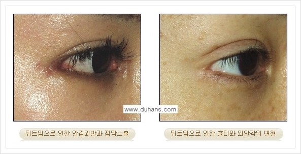 [두한성형외과 경쟁력 쌍꺼풀 재수술, 극한 눈재수술] - [뒤트임 수술의 부작용 및 교정 방법 안내] 관련 이미지 9