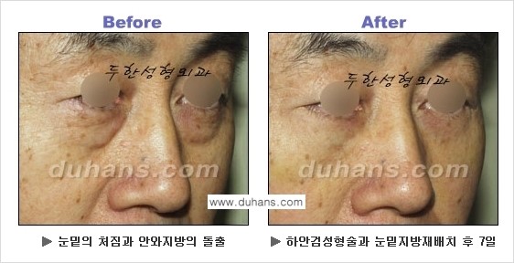 [두한성형외과의 상큼하고 환한 젊은 눈매완성] - [하안검 성형술 ②] 관련 이미지 30