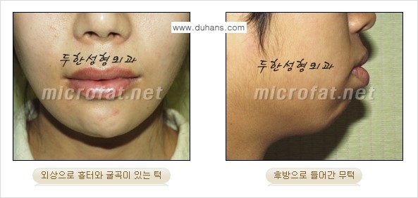 [두한성형외과의 경쟁력 미세지방이식] - [무턱교정 - 턱 미세지방이식 안내 1.] 관련 이미지 4