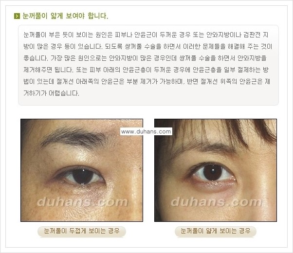 ​[두한성형외과 경쟁력 눈성형] - [자연스럽고 아름다운 쌍꺼풀의 기준] 관련 이미지 4
