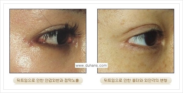 [두한성형외과 경쟁력 있는 쌍꺼풀 재수술] - [뒤트임 수술] 관련 이미지 11