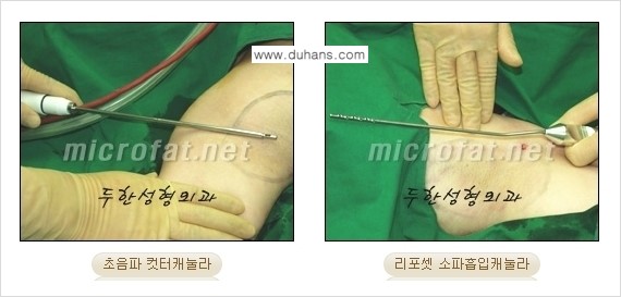 [두한성형외과 경쟁력 액취증, 다한증 치료] - [겨드랑이의 참기 힘든 냄새와 땀 치료 - 초음파 컷터지방흡입 + 리포셋 소파흡입술] 관련 이미지 10