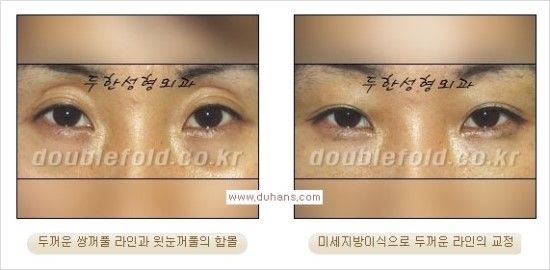 [두한성형외과 경쟁력 눈성형] - [쌍꺼풀 재수술 과정과 쌍꺼풀 재수술 실패의 원인, 쌍꺼풀 재수술의 성공 요건] 관련 이미지 40