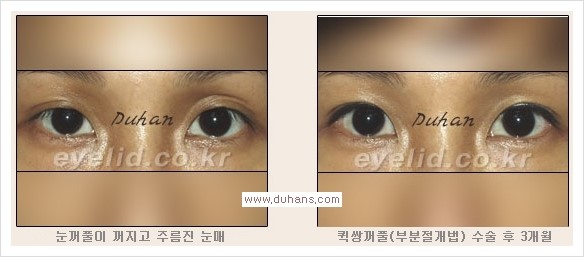 [두한성형외과 경쟁력 눈성형] - [퀵쌍꺼풀(부분절개법) 안내] 관련 이미지 4