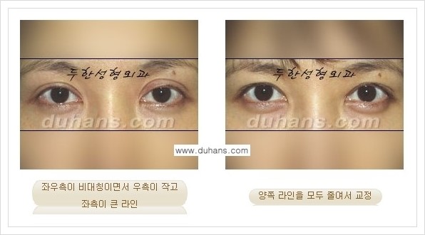 [두한성형외과 경쟁력 쌍꺼풀 재수술, 극한 재수술] - [비대칭(짝짝이) 쌍꺼풀 라인 교정 안내] 관련 이미지 6