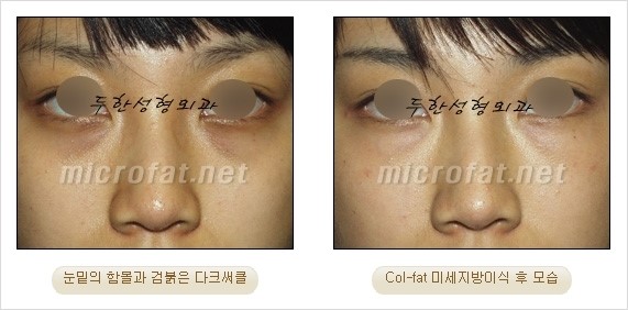[두한성형외과 경쟁력 눈밑성형] - [Dr. 컬럼 - 눈밑 다크써클의 치료 방법과 치료 효과] 관련 이미지 6