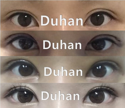 [Duhan Plastic Surgery Double Eyelid Revision] - [Reducing the Double Eyelid Line] image 7