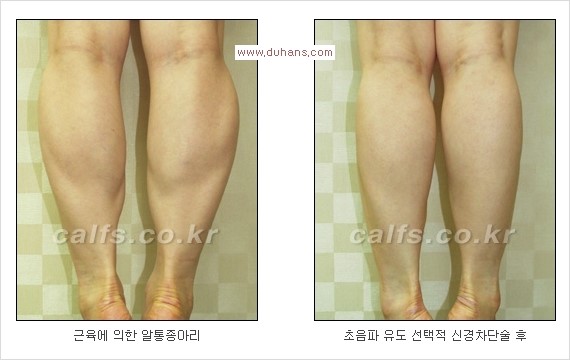 ⁠⁠[두한성형외과 경쟁력 종아리성형] - [굵은 다리의 모양과 원인에 따른 종아리성형 방법] 관련 이미지 11
