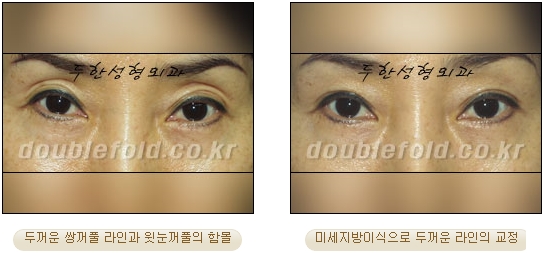 [두한성형외과 눈재수술] - [지방이식과 쌍꺼풀재수술 동시에 하는 경우] 관련 이미지 10