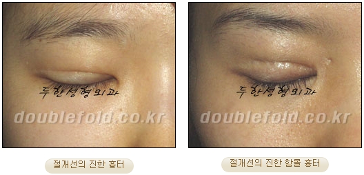 [두한성형외과 쌍커풀재수술] - [심한 소세지눈, 두줄따기, 쌍꺼풀 흉터] 관련 이미지 40