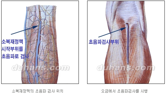 [두한성형외과 정맥류] - [하지정맥류, 정맥확장증, 혈관확장증] 관련 이미지 7