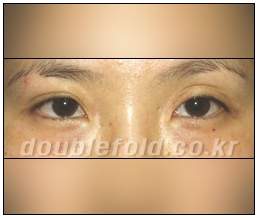 [Eye Reoperation Duhan Plastic Surgery] - [Guide to Double Eyelid Revision Surgery] image 9
