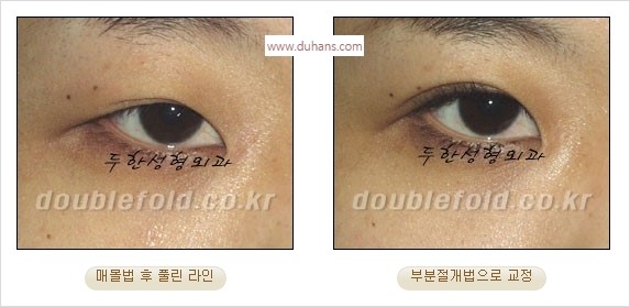 [두한성형외과 경쟁력 쌍꺼풀 재수술] - [풀린 라인 교정(Correction released fold line) 방법] 관련 이미지 7