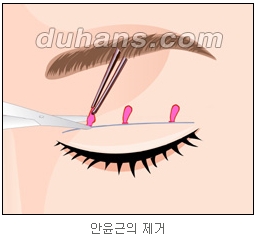 쌍커풀수술 두한성형외과 - 나에게 맞는 눈성형은? 관련 이미지 21