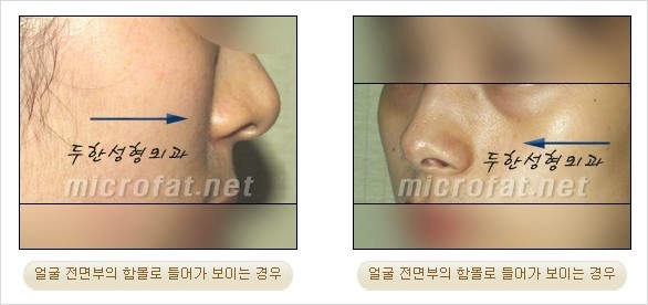 [두한성형외과 경쟁력 미세지방이식] - [귀족수술 입체 미세지방이식] 관련 이미지 2