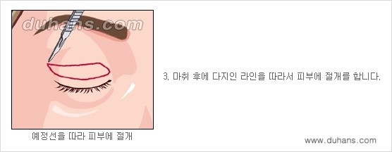[두한성형외과 성형 FOCUS] - [젊고 환한 눈매 상안검성형 안내] 관련 이미지 4