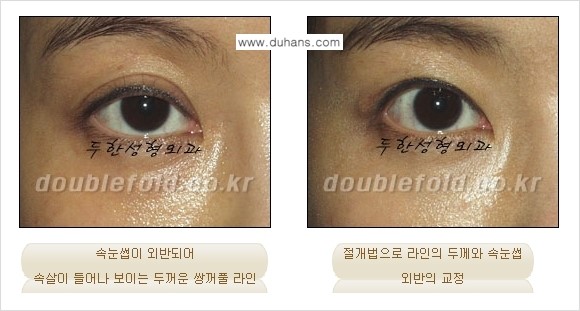 [두한성형외과 경쟁력 쌍꺼풀 재수술, 극한 눈재수술] - [쌍꺼풀 재수술 방법 - 속눈썹 외반] 관련 이미지 7