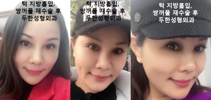 [두한성형외과 쌍커풀재수술] - [개인의 눈매와 특성에 맞는 쌍커풀재수술] 관련 이미지 8