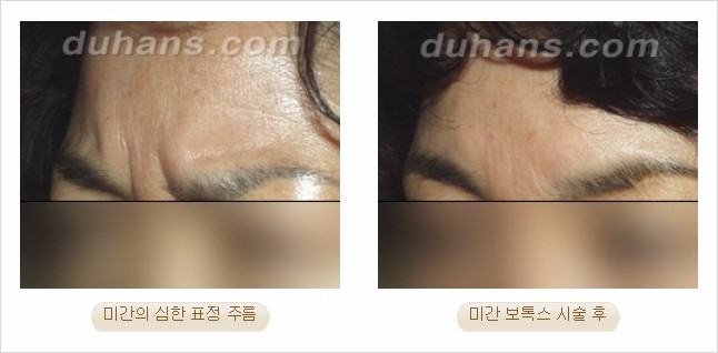 [두한성형외과 경쟁력 Quick 주름성형] - [주름교정을 위한 간편한 보톡스(보툴리눔톡신)] 관련 이미지 8